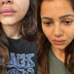 Rubina Dilaik Shares Pics of Her Swollen Face And Duck Lips, Fans Say We are Worried For You